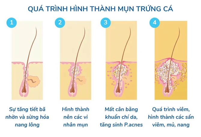Nguyên nhân bị mụn lưng Nguyên nhân bị mụn lưng
