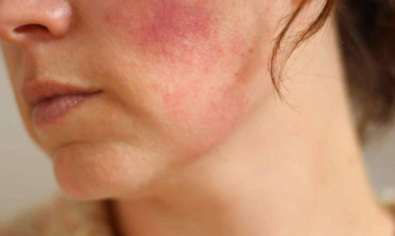 Tác dụng phụ của corticoid trong mỹ phẩm