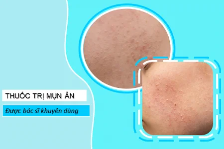Mụn ẩn và thuốc trị mụn ẩn được bác sĩ khuyên dùng Mụn ẩn và các sản phẩm được bác sĩ khuyên dùng