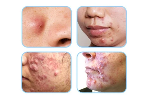 Các loại mụn sưng viêm thường gặp Các loại mụn sưng viêm thường gặp