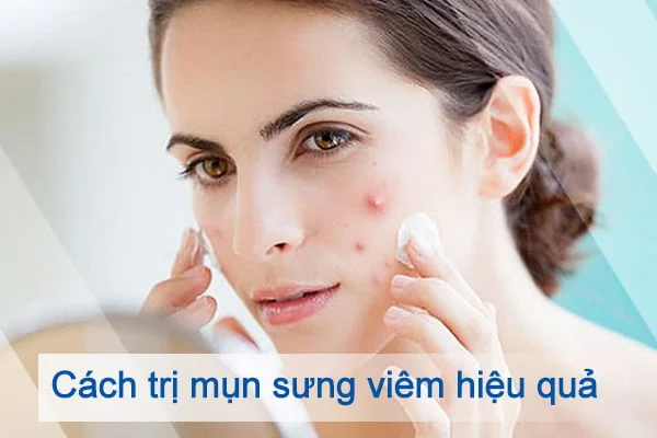 Cách trị mụn sưng viêm hiệu quả Cách trị mụn sưng viêm hiệu quả