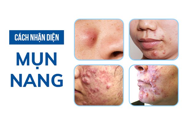 Nhận diện mụn u nang Nhận diện mụn u nang