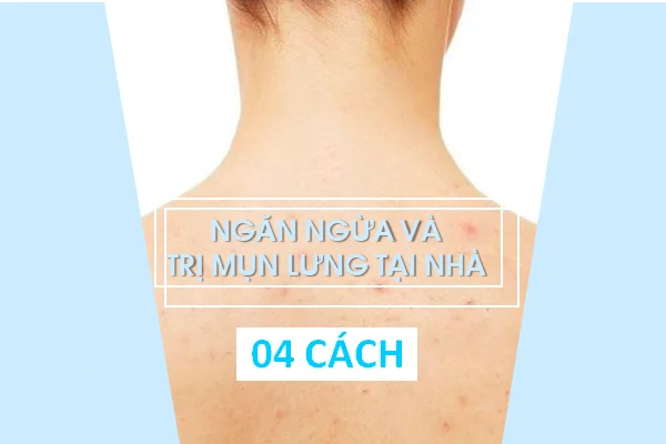 Cách trị mụn lưng tại nhà hiệu quả Cách trị mụn lưng tại nhà hiệu quả