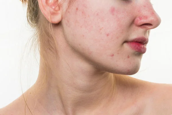 Cách chọn sữa rửa mặt với da mụn
