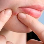 Cách trị mụn viêm mủ chuẩn y khoa