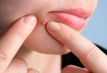 Cách trị mụn viêm mủ chuẩn y khoa