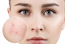 Mụn viêm dưới da: nguyên nhân, cách điều trị và phòng tránh