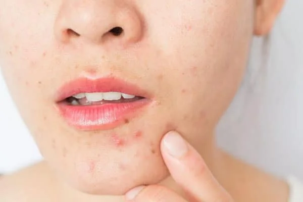 Peel da đẩy mụn trong bao lâu?