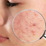 Khám mụn ở đâu? Chi phí trị mụn bao nhiêu?