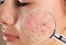 Khám mụn ở đâu? Chi phí trị mụn bao nhiêu?