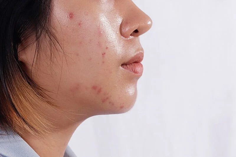Các sản phẩm skincare cho da dầu mụn tốt nhất