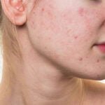 Cách chữa da mặt bị dị ứng mỹ phẩm tại nhà