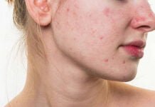 Cách chữa da mặt bị dị ứng mỹ phẩm tại nhà