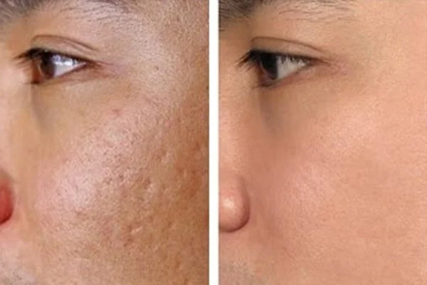 Việc lựa chọn điều trị sẹo rỗ phụ thuộc vào nhiều yếu tố