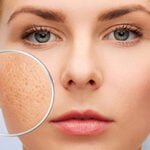 Trị sẹo rỗ bao nhiêu tiền? Trị sẹo rỗ bao nhiêu tiền?