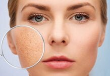 Trị sẹo rỗ bao nhiêu tiền? Trị sẹo rỗ bao nhiêu tiền?