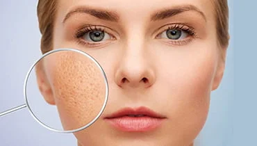 Trị sẹo rỗ bao nhiêu tiền?