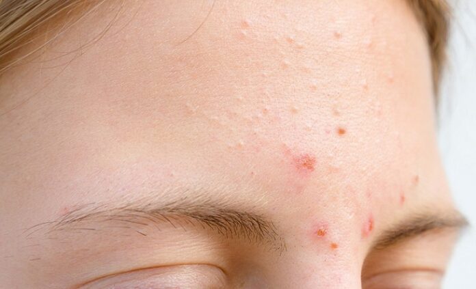 nguyên nhân gây mụn ẩn nguyên nhân gây mụn ẩn